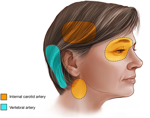 Figure 6 Headache or neck pain locations with internal carotid (pink) and vertebral artery dissections (green).