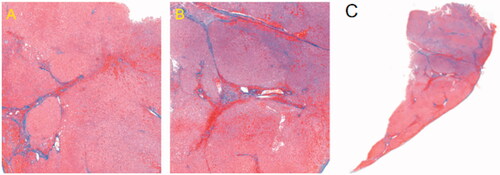 Figure 6. Masson-stained liver tissue. (A) Normal hepatocytes. (B) Coagulated hepatocytes after MW ablation. (C) Upper zone of complete cell death, an intermediate zone of partial cell death, and lower zone in which cells are viable.
