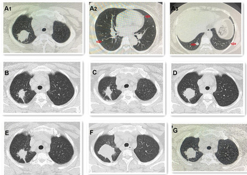 Figure 1 The chest CT outcomes during the whole treatment. (A) (A1–A3) Chest CT reveals primary lung cancer and metastases (red arrow); (B) tumor was PR after 2 cycles chemotherapy and gefitinib; (C) tumor was SD after 2 cycles chemotherapy and gefitinib again; (D) tumor was PD for taking gefitinib only; (E) tumor was PR again after 4 cycles the same chemotherapy and osimertinib; (F) tumor was PD again for taking osimertinib only. (G) Tumor was PR again after 2 cycles anlotinib.