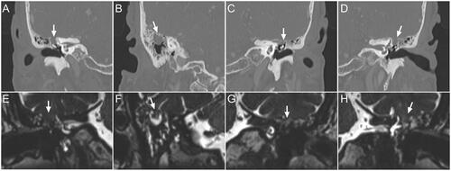 Figure 2. Preoperative CT and MRI revealed bilateral multiple meningoencephaloceles in the middle cranial fossa. (A,B) Preoperative CT of coronal sections showed lesions with soft tissue density (arrows) that were identified both in the mastoid and attic of the right ear. (C,D) As seen in the right ear, lesions with soft tissue density (arrows) were observed in the antrum and attic of the left ear. (E–H) MRI of coronal sections demonstrated protrusion of brain tissue continuing from the brain parenchyma and surrounded by fluid collection (arrows), suggesting encephaloceles containing cerebrospinal fluid. CT: computed tomography; MRI: magnetic resonance imaging.