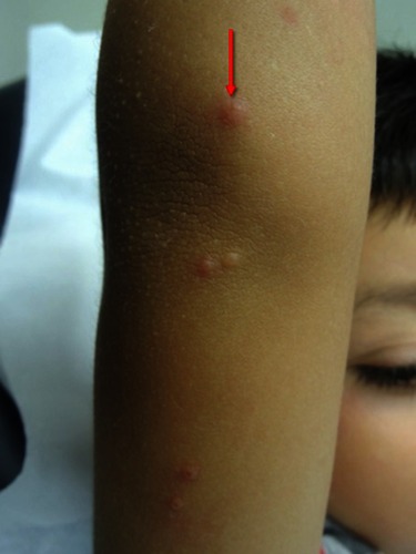 Figure 2 Swelling and erythema of the “BOTE” sign.