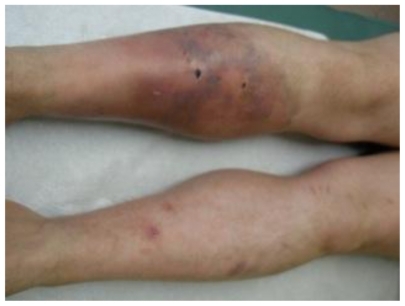 Figure 10 Male 30 years old, crushing accidental trauma on right leg. Before REAC-TO treatment.
