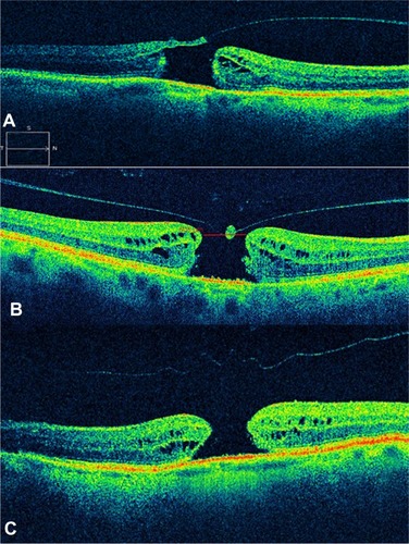 Figure 6 Full-thickness macular hole classification.