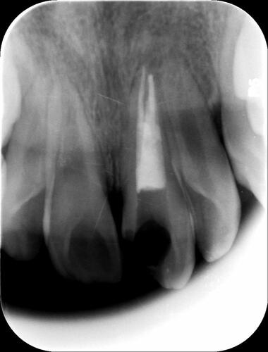 Figure 5 Radiographical view immediately after obturation of root canals.