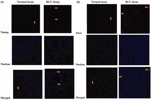 Figure 2. Nanog (A) and Oct4 (B) protein expressions in RCC and paracancerous tissues detected by immunofluorescent staining method.