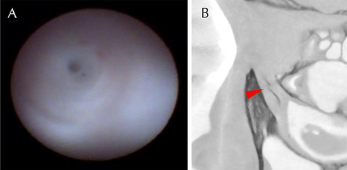 Figure 1 Complementary findings of DE and DCG. (A) DE showed a micro-hole in the center of the obstructed site in NLD. Complete or partial obstruction was not clearly visible in the endoscopic images. (B) Sagittal DCG image showed contrast passage, and the site was confirmed as a partial obstruction (arrowhead). The original DCG images were converted to monochrome to facilitate the observation of the contrast media.