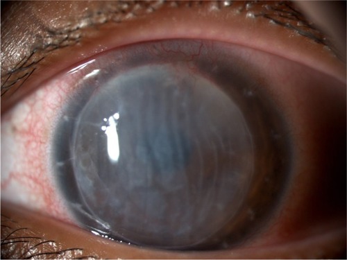 Figure 1 Clinical picture of corneal endothelial graft rejection at baseline.