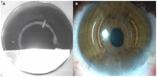 Figure 2 (A) Intraoperative image of intrastromal channel creation with femtosecond laser; inferior half of the cone was covered by a gelatinous paper. (B) Postoperative first-month slit-lamp image of the cornea showing the inferiorly thin and vascularized cornea and temporal and nasal placement of the intracorneal ring segments.