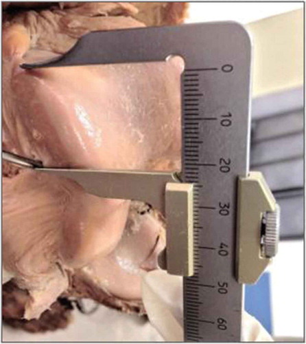 Figure 6. Height of the guidewire exit point in relation to the anteroposterior measurement of the lateral femoral condyle.Source: Anatomy Laboratory–UNIRIO, 2014–2015.