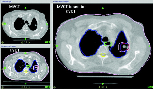 Figure 1.  Pre-treatment MVCT for image guided Stereotactic Body Radiotherapy for T1/2 N0 M0 non-small cell lung cancer. Observe that the motion encoded treatment target lies fully within the motion defined PTV.