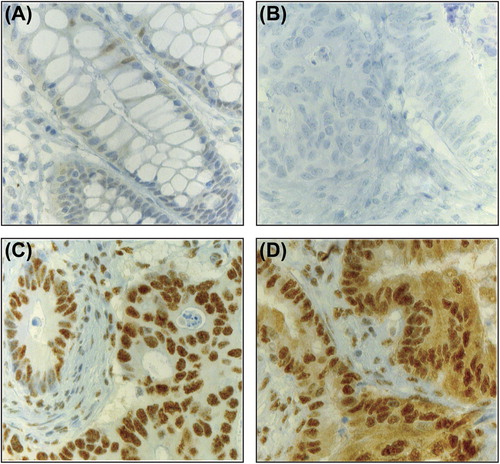 Figure 1. Immunohistochemistry for maspin. (A) Normal colon. (B) Colon tumor, negatively stained. (C) Colon tumor, strong nuclear staining. (D) Colon tumor, strong nuclear and intermediate cytoplasmic staining.