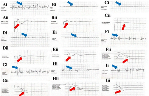 Figure 4 Neuro-electrophysiological study. For patients with neuralgic amyotrophy during the acute Brucella infection stage, there is positive sharp waves and fibrillation potential in the muscles innervated by the affected peripheral nerves on electromyography, which suggest numerous denervation signs (Ai–Ii :deltoid, latissimus dorsi, pectoralis major, infraspinatus, biceps brachii, triceps brachii, abductor pollicis brevis, extensor digitorum communis muscle, interosseous muscles, blue arrow) and reduced amplitudes of compound muscle action potentials can be observed in the affected peripheral nerves manifesting multifocal axonal loss from affected peripheral origin except for ulnar nerve (Aii–Iii: axillary nerve, thoracodorsal nerve, lateral thoracic nerve, suprascapular nerve, musculocutaneous nerve, radial nerve, median nerve, radial nerve, ulnar nerve, red arrow).