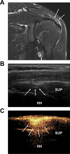 Figure 4 Symbolic figure of partial-thickness RCT on the SUP. (A) The oblique coronal T2-weighed image showing the high signal in the avulsion site on the bursal surface of the SUP (↓↓). (B) The demonstration of two-dimensional ultrasound examination on the continuity of SUP in the middle segment (↓↓↓). (C) The mixture of contrast media diffuses within the bursa and enters the tendon with a strong echogenicity (↓↓↓↓), whilst not entering the surface of HH.