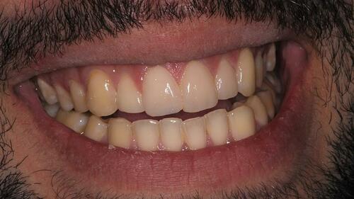 Figure 12 Postoperative smile.