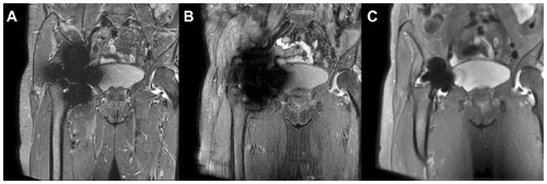 Figure 6 Coronal short tau inversion recovery (A), 2-point Dixon (B), and multiacquisition variable resonance image combination proton density weighted fat saturation (C) images of a resurfacing arthroplasty of the right hip at 3 T. The short tau inversion recovery image demonstrates the typical “four-leaf clover” signal voids seen in spherical metal implants. Although the signal-to-noise ratio is better with the 2-point Dixon, the artifact is worse. The multiacquisition variable resonance image combination sequence produces dramatic metal artifact reduction but is limited to a large field of view and blurring of the image.