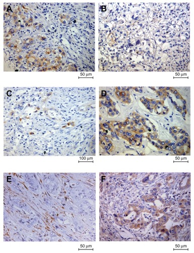 Figure 1 Representative immunohistochemical images of three epithelial-mesenchymal transition markers in intrahepatic cholangiocarcinoma. (A) E-cadherin was strongly expressed in the plasma membrane of the tumor cells; (B) demonstration of loss of membranous E-cadherin in tumor cells; (C) negative N-cadherin expression with a positivity less than 10%; (D) demonstration of N-cadherin in the membrane and cytoplasm of tumor cells; (E) negative expression of vimentin in cancer cells while stromal cells were positively stained; and (F) acquired vimentin expression in cancer cells.