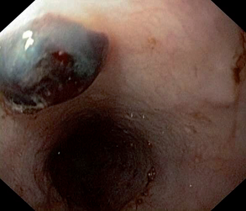 Figure 1. Upper gastrointestinal endoscopy in a 59-year-old woman presenting with melena and hematemesis revealing a round black foreign body in the mid-third of the esophagus identified as a leech.