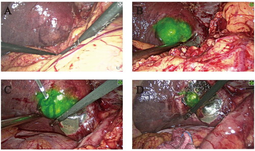 Figure 1. ICG- fluorescence imaging of the patient with liver cancer (Case 22). (A) Tumor images without ICG-fluorescence imaging (B) Tumor images with ICG-fluorescence imaging (C) Inserting the needle to ablate the tumor at the edge with ICG green fluorescence. (D) Tumor images with ICG-fluorescence imaging after MWA.