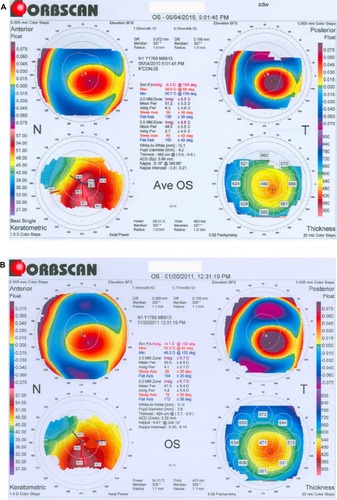 Figure 6 Tomography maps (Orbscan IIz, Bausch and Lomb, Rochester, NY, USA) before (A) and 9 months after (B) collagen crosslinking showing flattening of corneal surface. Maximum and minimum simulated keratometry values show a decrease of 2.8 and 1.5 diopters, respectively.