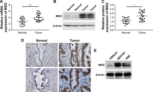 Figure 1 MSI2 is overexpressed in extrahepatic cholangiocarcinoma.