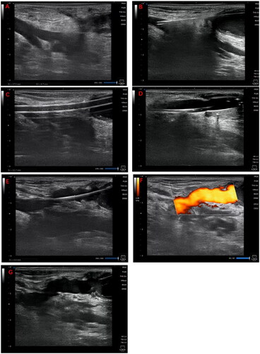 Figure 1. Illustrates the surgical procedure for sharp recanalization. (A) Using ultrasonography, the length and depth of the targeted vein are measured to devise the treatment plan. (B) An 18 G sharp needle is inserted through the fistula vein, penetrates the vessel wall, and advances through the subcutaneous tissue to reach the targeted vein. (C) A 6 F vascular sheath is introduced in stages. (D) A 6 mm × 4 cm balloon is inflated; (E–F) Ultrasonography is performed to ensure the vein is patent. (G) A subcutaneous hematoma is detected in the vicinity of the tunnel.