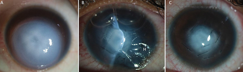 Figure 3. (a-c)- a: Slit-lamp photograph of the left eye when patient showing hydrops; b: Slit-lamp photograph of the left eye 1 h after the surgery shows significant resolution of peripheral corneal edema; c: Slit-lamp photograph at day 1 postoperative period.
