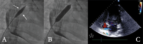 Figure 3. Marshal balloon inflation in the atrial septum at its early phase with balloon imprints (arrows) (A) and its late phase (B) and the created atrial septum defect (ASD) on color Doppler cardiac ultrasound (C).