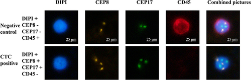Figure 1 CTCs were detected by negative enrichment combined with immunofluorescence in situ hybridization (im-FISH). CTCs have characteristics such as CD45-, DAPI+ and chromosome 8 or 17 fluorescent probe signal point ≧3.