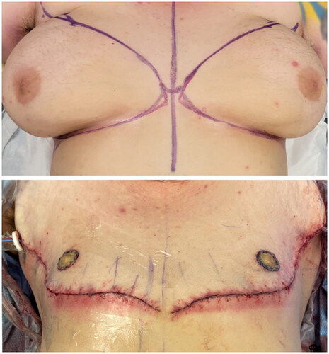 Figure 2. Pre-operative patient surgical markings and immediate post-operative result after double opposing mastectomy with free nipple graft, POD 0.