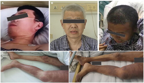 Figure 1. The hair depigmentation (A–C) and the radiation recall dermatitis (D,E) before and after taking pazopanib.