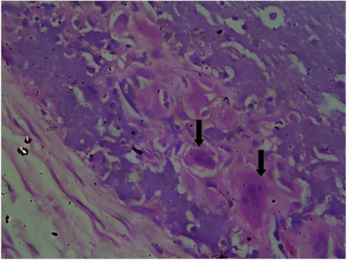 Figure 5 Photomicrograph of a case of idiopathic scrotal calcinosis. showing foreign body giant cell reaction.