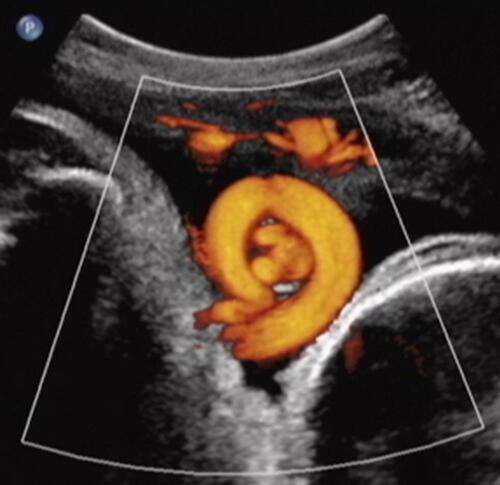 Figure 6 Power Doppler sagittal view of vertex-presenting fetus at 37 weeks’ gestation (fetal cranium on the right). Note depiction of true knot of umbilical cord (“smiley” sign), within the nuchal cord. Reproduced with permission from Sherer DM, Dalloul M, Ward K, et al. Coexisting true umbilical cord knot and nuchal cord: possible cumulative increased risk of adverse perinatal outcome. Ultrasound Obstet Gynecol. 2017;50(3):404–405. Copyright © 2016 ISUOG. Published by John Wiley & Sons Ltd.Citation11