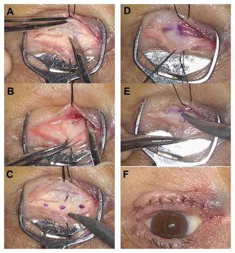 Figure 1 (A–F) These photographs help us understand the actual surgery. Eyelid pinch cramped the lower eyelid for hemostasis, and 4-0 silk sutures retracted the eyelid skin for the separation of the skin and the orbicularis. (A) The dissection of the posterior layer of the capsulopalpebral fascia (CPF). First, cut the CPF complex at the inferior border of the tarsus. Visualize the conjunctiva on the silver plate of the pinch and dig along the layer. Avoid puncturing the conjunctiva. (B) The dissection of the anterior layer of the CPF. Second, locate the orbital fat layer beneath the septum. Dig down that layer inferiorly, approximately 7–8 mm from the tarsus. (C and D) CPF advancement. Three points were marked with a skin marker on the tarsus and 5 mm inferiorly from the cut end of the CPF. The dissected CPF was sutured to the tarsus with three sutures of 6–0 polysorb. (E) Ciliary everted suturing. Nylon suture (7-0) tied dermis and tarsus, resulting in eversion of the cilia. Normally, five or six stiches are needed. (F) Direction of cilia at the end of the surgery. All cilia are corrected to their normal positions. Palpebration has no influence on the ciliary position.