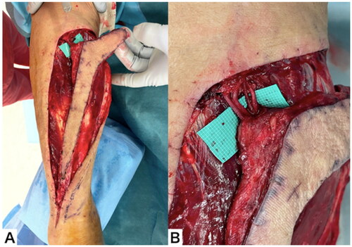 Figure 3. Elevation of the RSAF. (A) The flap after elevation. (B) The proximal pedicle included an artery, two veins, and a nerve.