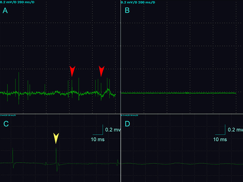 Figure 1 Electromyographic recordings of the two groups. (A) The MTrP group rats show abnormal SEA during EMG (red arrows). (B) The EMG waveform of rats in the control group was approximately a straight line. (C) The yellow arrow indicates the fibrillation potential as and represents the initial positive and negative biphasic waves. (D) The control group shows normal spontaneous potentials (endplate noise). (A and B) The sensitivity of the EMG device is 0.2 mv/grid, and the scanning speed is 200 ms/grid. (C and D) The sensitivity of the EMG device is 0.2 mv/grid, and the scanning speed is 10 ms/grid. n=15 rats in the MTrP group and n=10 rats in the control group.