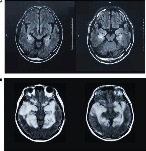 Figure 1 MRI scans of two patients (A, patient MN; B, patient YI) with encephalitis-induced damage to the medial temporal lobe. In MN, the images were obtained 6 weeks after the onset of the disease. In YI, the images were obtained 3 weeks after the onset of the disease.