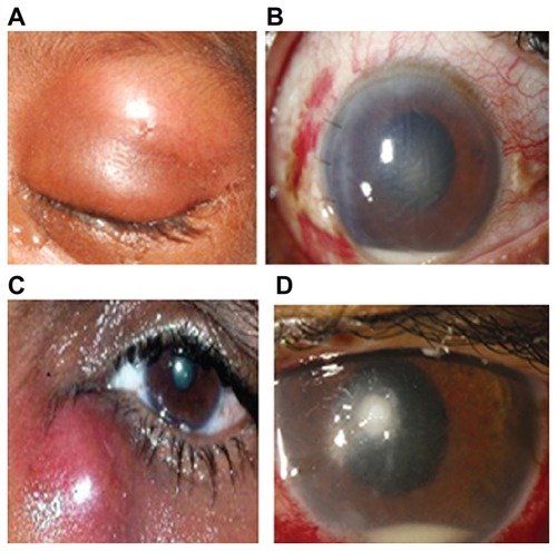 Figure 1 (A) Swollen erythematous eyelid in a case of orbital cellulitis; (B) slit-lamp picture of a case of endophthalmitis showing central corneal edema with hypopyon; (C) abscess of lacrimal sac secondary to acute dacryocystitis; (D) slit-lamp picture showing localized stromal infiltrate with hypopyon.