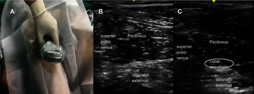 Figure 2 Ultrasound-guided proximal obturator nerve block. (A) Patient is in supine position with the thigh slightly abducted and externally rotated. The transducer is placed on the medial aspect of the inguinal crease and then tilted 40–50 degrees cranially. (B) The superior pubic ramus, the pectineus, and obturator externus muscles are defined. (C) A needle is inserted into the fascial interface plane between pectineus and obturator externus using in-plane ultrasound guidance in a lateral-to-medial direction, then local anesthetic is injected.