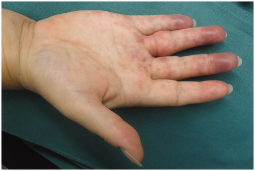 Figure 1. Marbled ischemic aspect of ulnar three digits. Injection site visible proximal to wrist crease.