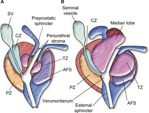 Figure 2 Prostate zonal anatomy.