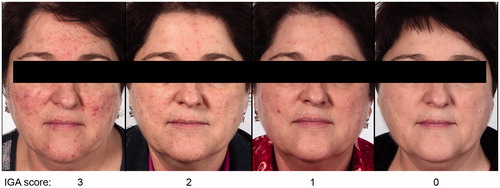 Figure 6. Representative photographs with the corresponding Investigator Global Assessment (IGA) scores after treatment with once-daily ivermectin 1% cream.