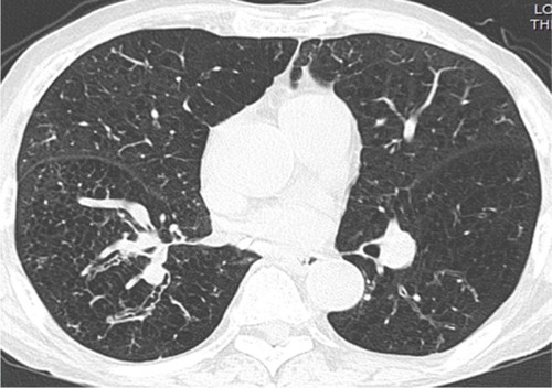 Figure 1 Axial CT image with a lung-window setting showing diffuse emphysema with varicose bronchiectasis in the right lower lobe and tubular bronchiectasis in the left lower lobe.Abbreviation: CT, computed tomography.