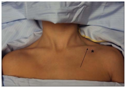 Figure 9 The “break” of the clavicle (arrow) and position of appropriate cutaneous puncture (black star). Note that head and neck drapes must always be placed with care to avoid potential airway obstruction and to allow appropriate airway assessment.