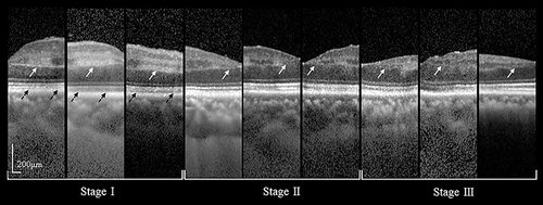 Figure 1 SD-OCT characteristics of different stages of PAMM lesions in APAC or APACG eyes. Stage I (edema): hyper-reflective lesions involving the INL (white arrow) along with the shadowing effect they created (black arrow) and some lesions extended into IPL and OPL. Stage II (edema resolution): severe attenuating OPL thickness (white arrow) along with the corresponding shadow partially resolved. Stage III (atrophy): a legacy of INL thinning and irregular, attenuated OPL (white arrow) along with hyper-reflective lesions resolved.