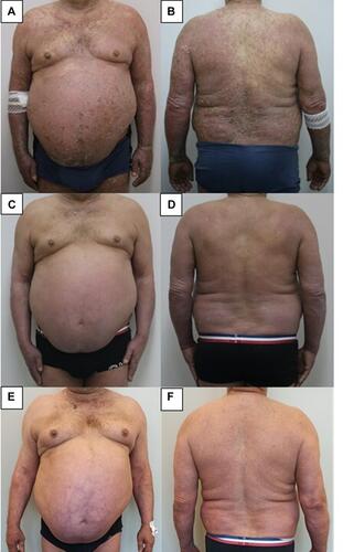 Figure 2 Case 2 (A and, B) widespread erythematous plaques with coalescing pustules on day 0; (C and, D) significant improvement with residual erythema on the trunk and upper limbs at week 2; (E and, F) erythema on the trunk and limbs and residual psoriatic plaques on the elbows at week 30.