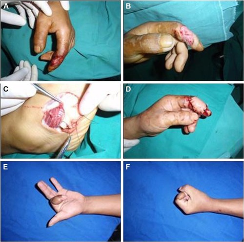 Figure 2 Electrical injury to the left index finger treated with the free LTA flap (Case 1).