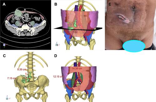 Figure 4 Secondary abdominal wall tumor. (A) Transverse section examination of CT. (B) Three-dimensional reconstruction of tumor (green marker). (C) Abdominal wall. (D) Size of tumor. (E) Abdominal wall defect.