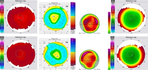 Figure 1 OD and OS Topolyzer topographic scans pre-op, Pentacam anterior elevation pre-op, HOAs pre-op, post-op 1 year Topolyzer scans for Sample case 1.