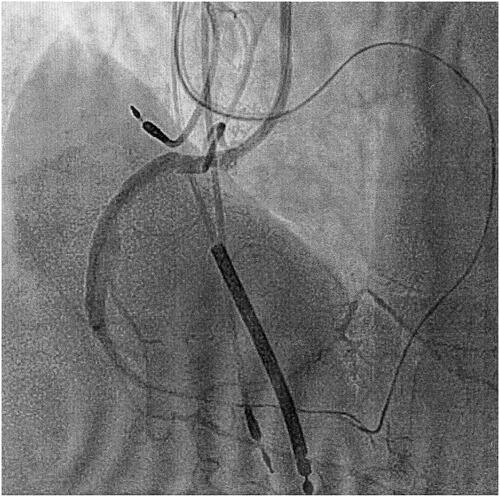 Figure 2. Appearance of the iconic shadow of the heart immediately after injection of the contrast dye in the right coronary artery, while the path of the left coronary system is evidenced by the path of the microcatheter previously deployed in a context of a retrograde approach (left anterior oblique projection 30°). These images are regularly obtained at coronary angiography performed during recanalization of a CTO. Contemporaneous visualisation of the right and left coronary trees form the exact shape of what we have been used to recognise as ‘the human heart’.