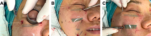 Figure 6 Jowl fat compartment repositioning. (A) The suture needle is inserted perpendicular to the skin at point 1. A metal ring is used to ensure eyeball protection while guiding the needle through the ORL. (B) The needle passes through the nasolabial fat compartment and exits at point 3. (C) The suture needle is guided into the catheter needle for extraction.